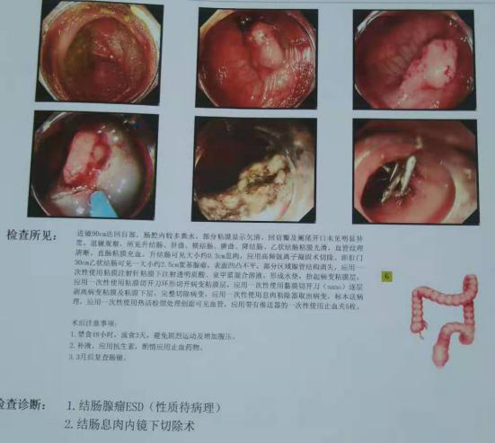 年轻女子全胃长满肿瘤，警惕胃癌年轻化警钟敲响