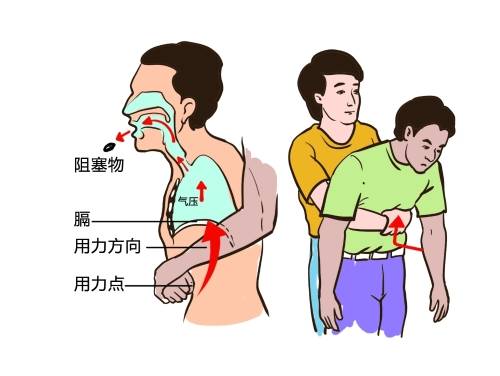 海姆立克急救法，最直观的急救方法