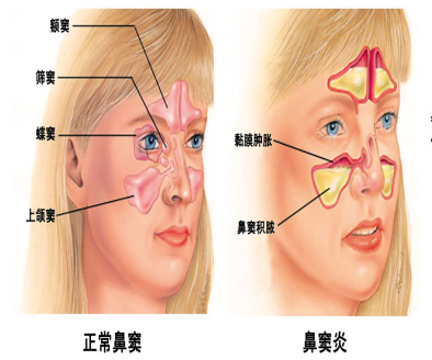 鼻窦炎的症状与表现解析