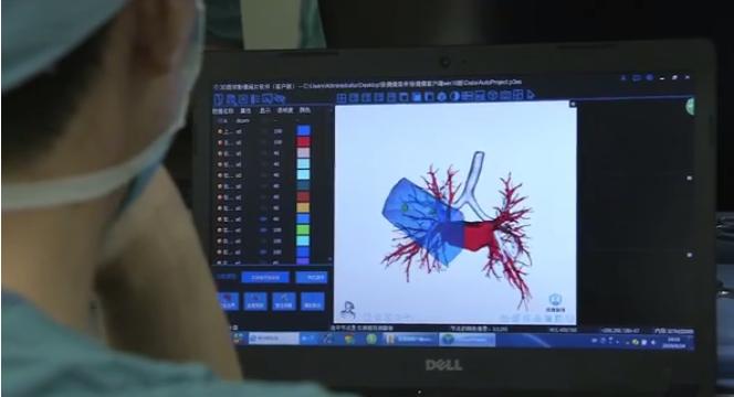 70岁老人肺部肿瘤生存期限探讨