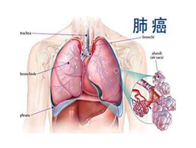 肺腺瘤最佳治疗方法探讨与研究